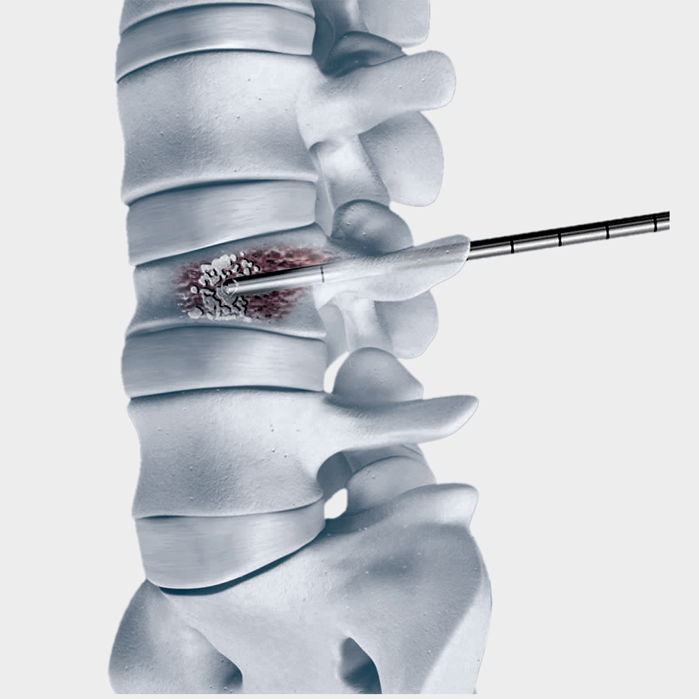 vertebroplasty surgery