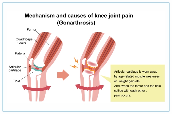 best doctor for Knee Pain in Sonipat